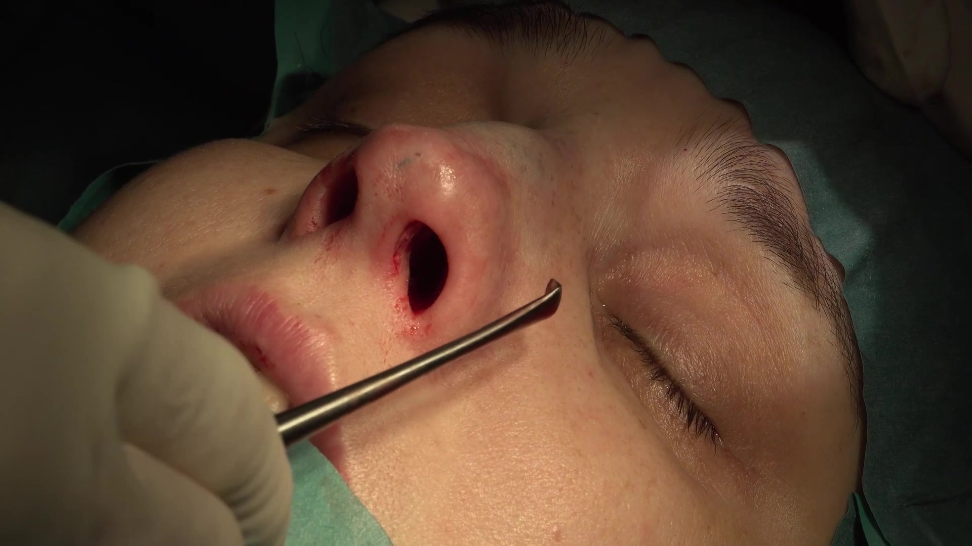 健康・医学 Preservation Rhinoplasty Preservation Rhinoplasty Merges with Structure Rhinoplasty