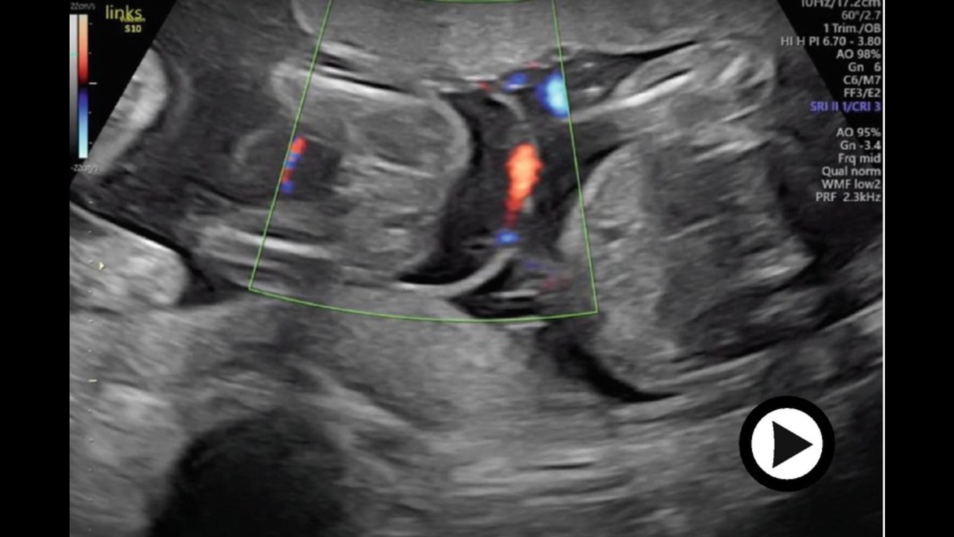 Placentation in Multiple Pregnancy | SpringerLink