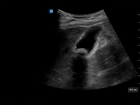 Chronic Cholecystitis Ultrasound Wes Sign