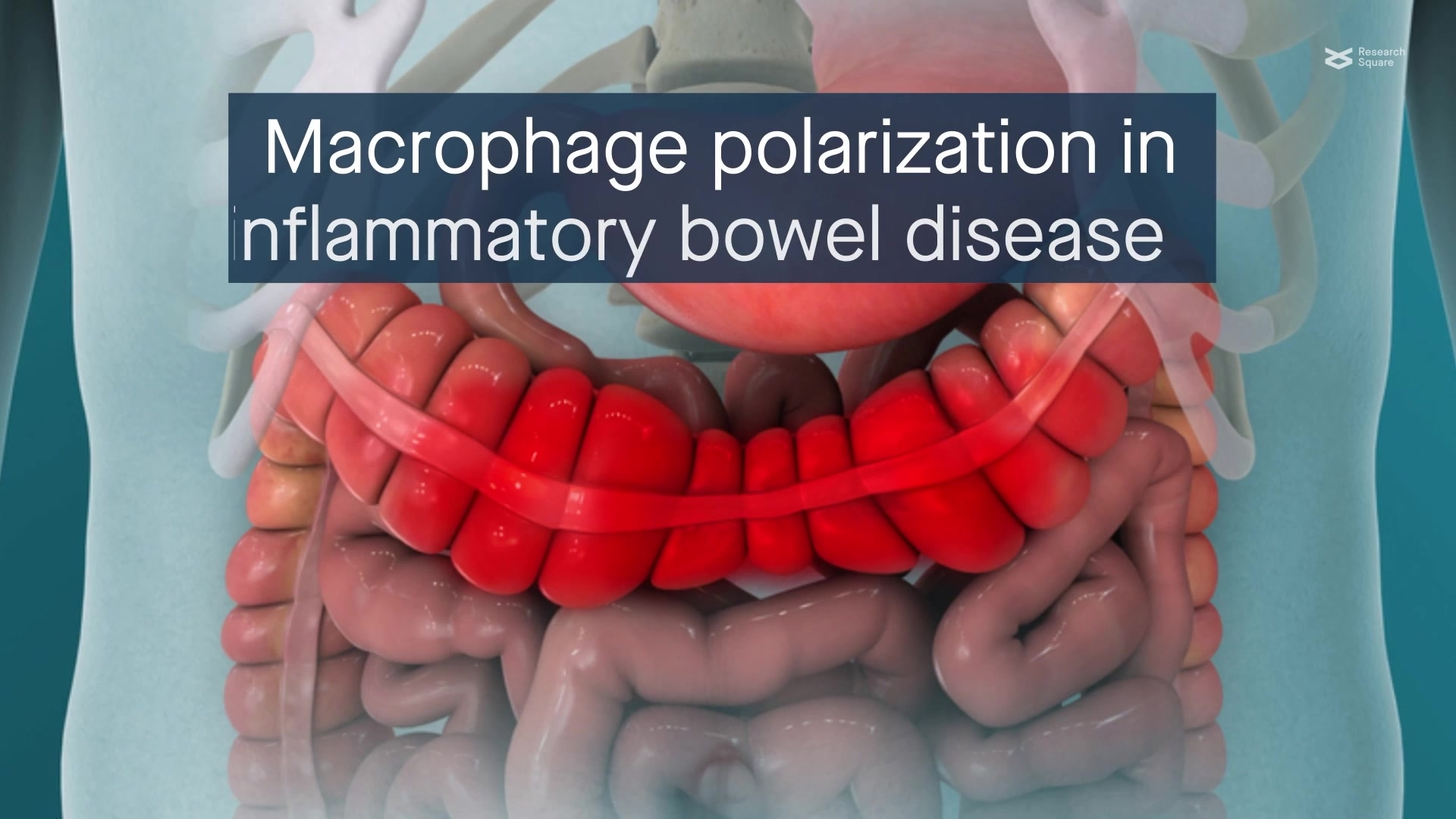 Macrophage polarization in inflammatory bowel disease | Cell