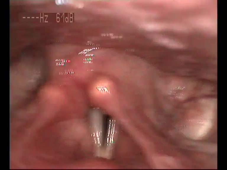 Special Kinds and Clinical Manifestation of Voice Disorders