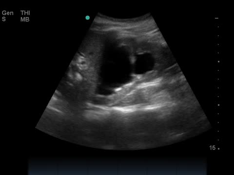 Abnormal Bladder Ultrasound