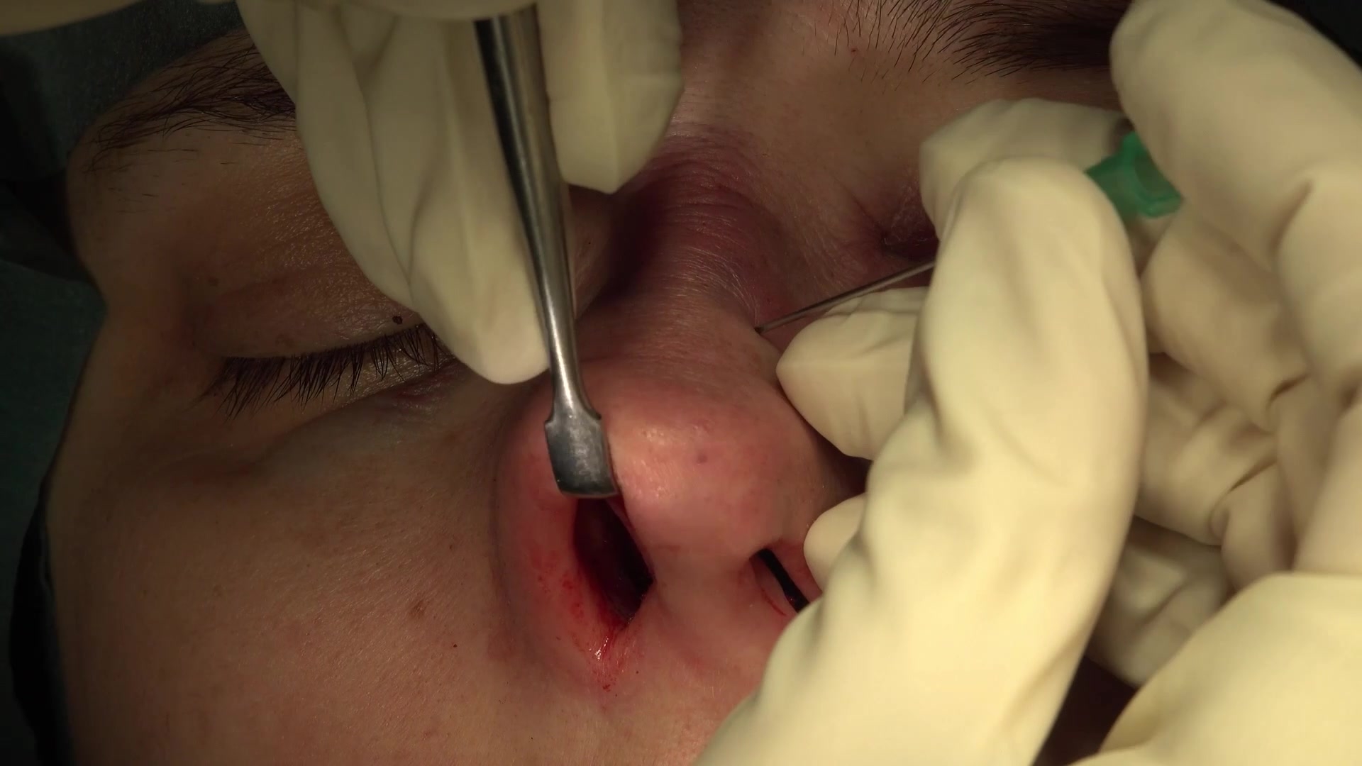Closed Piezo Preservation Rhinoplasty | Aesthetic Plastic