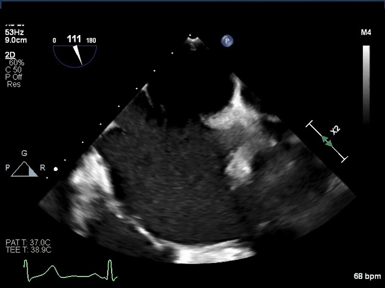 Endocardial Cushion Defect Echo